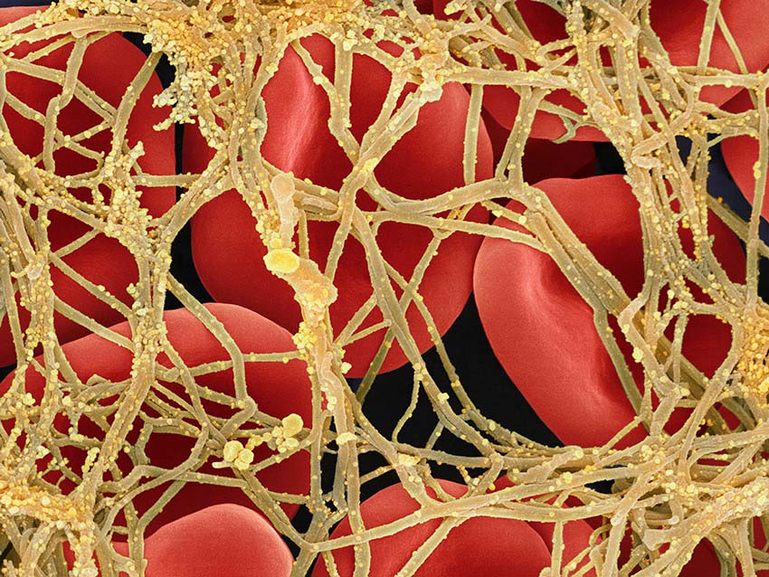 A blood clot and activated platelets