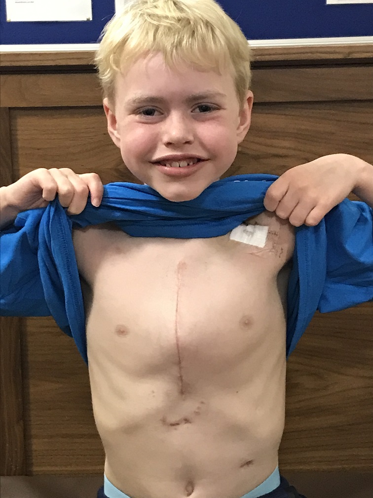 Max displays his operation scar, smiling