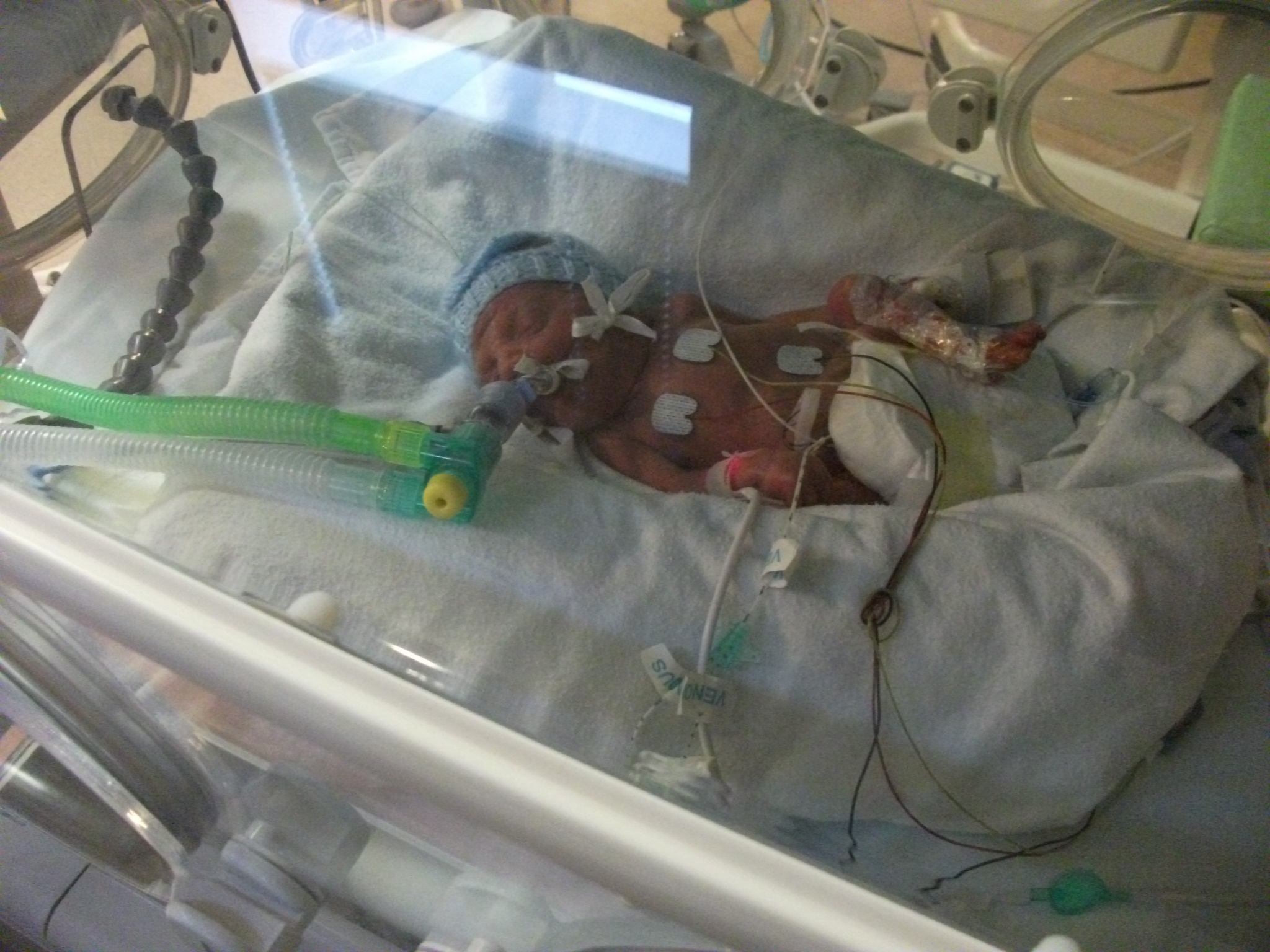 Baby Sebastian in an incubator