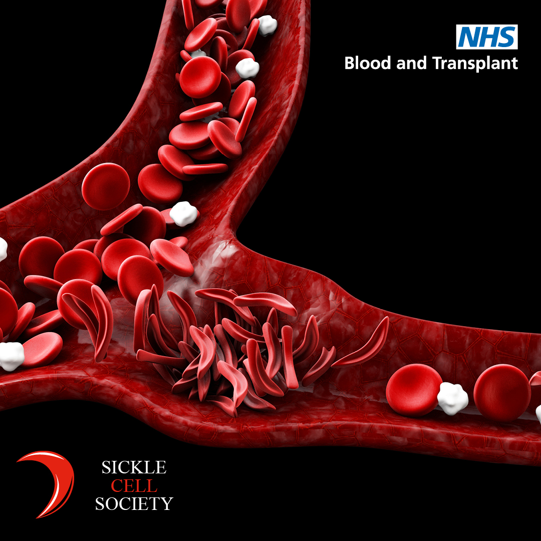 Sickle Cell Awareness Day 2020 NHS Blood and Transplant