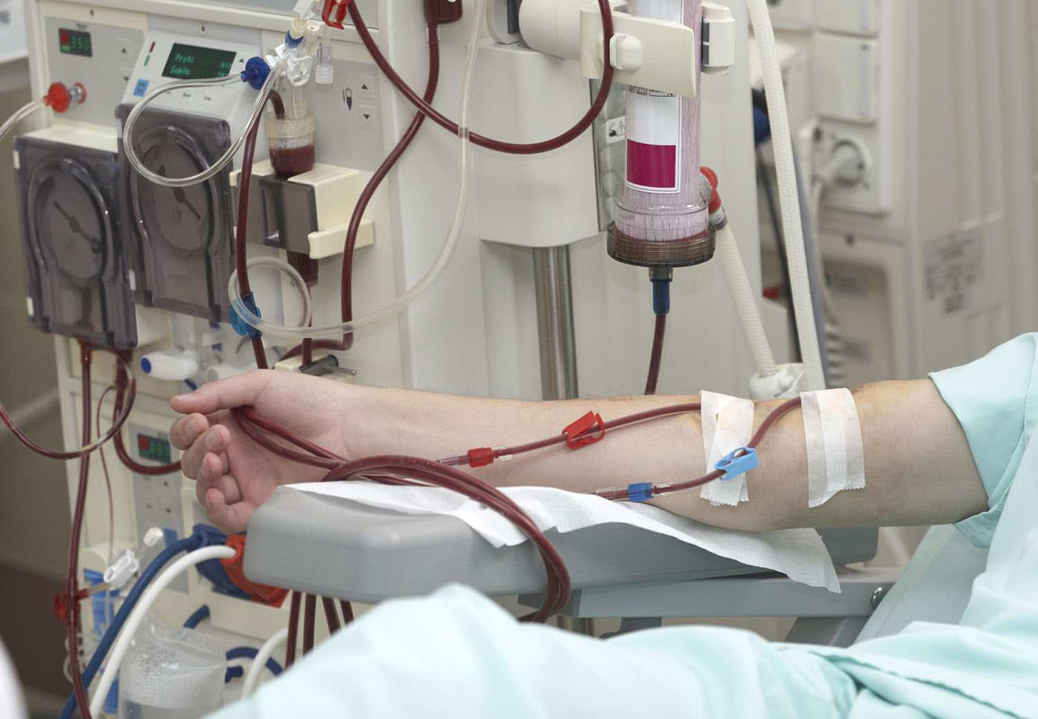 A dialysis patient's arm attached to a haemodialysis machine