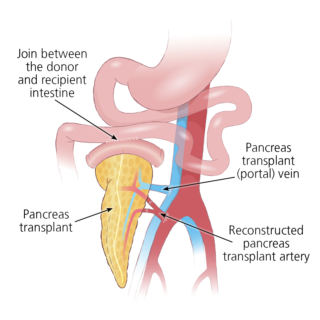 Illustration of a pancreas transplant, showing the join between the donor and recipient intestine, pancreas transplant portal vein and reconstructed pancreas transplant artery