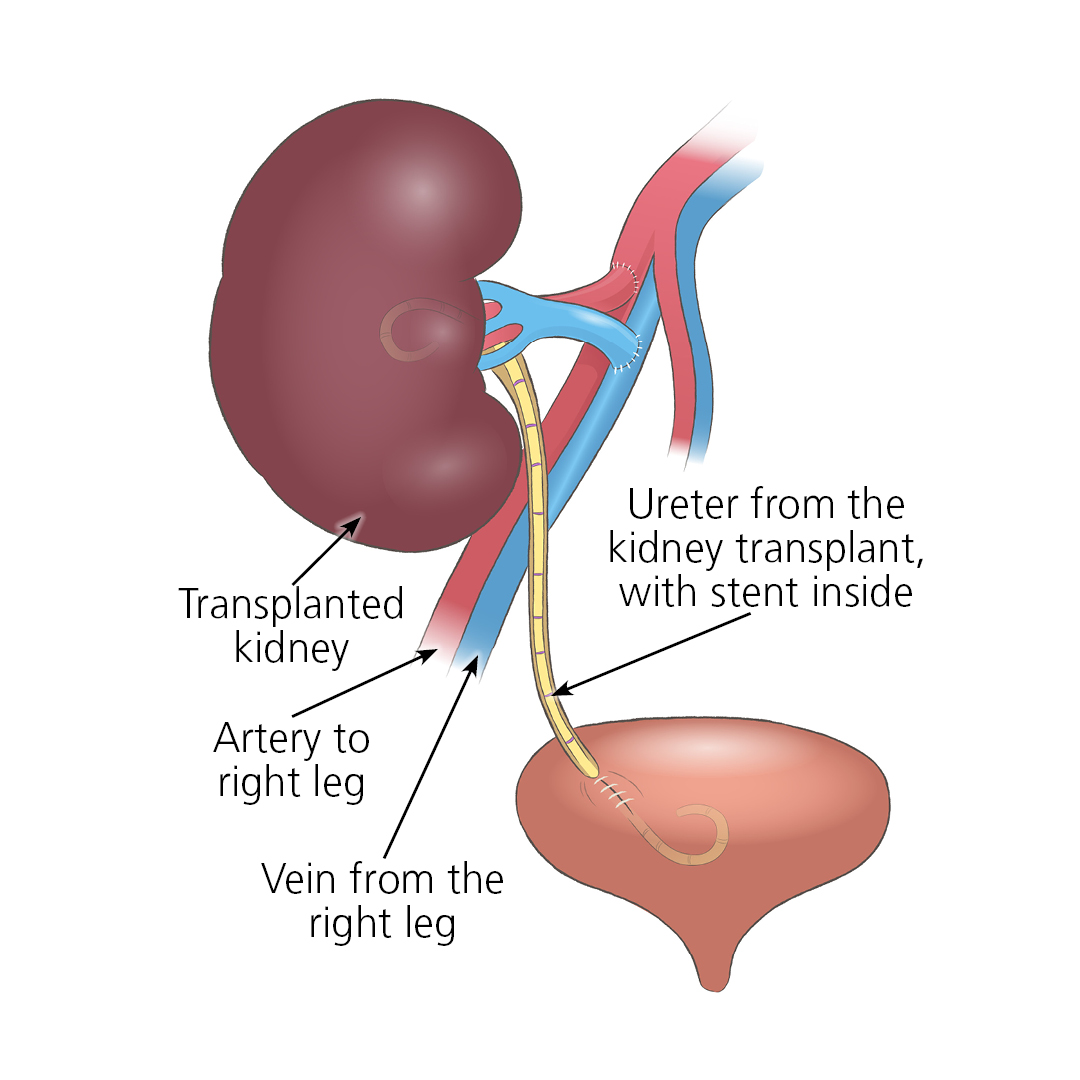 Illustration of a transplanted kidney connecting to an artery to the right leg, a vein from the right leg and ureter from the kidney transplant with a stent inside