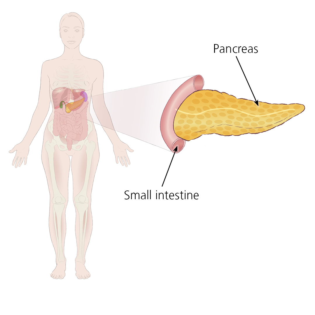 Illustration showing how a donated pancreas connects to a patient via the small intestine