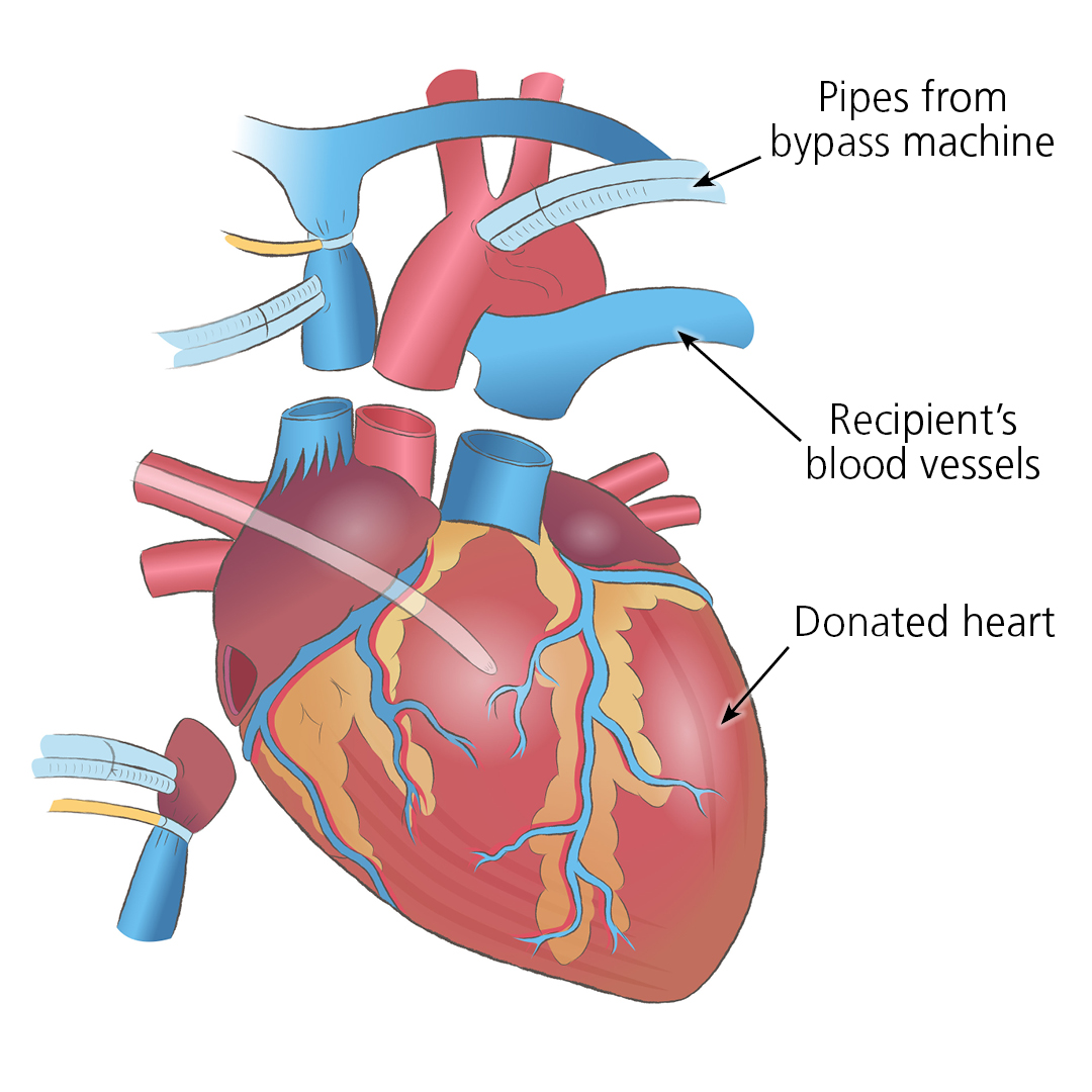Heart Transplant Surgery Organ Transplantation NHS Blood And Transplant Heart Transplant Surgery Organ Transplantation NHS Blood And Transplant