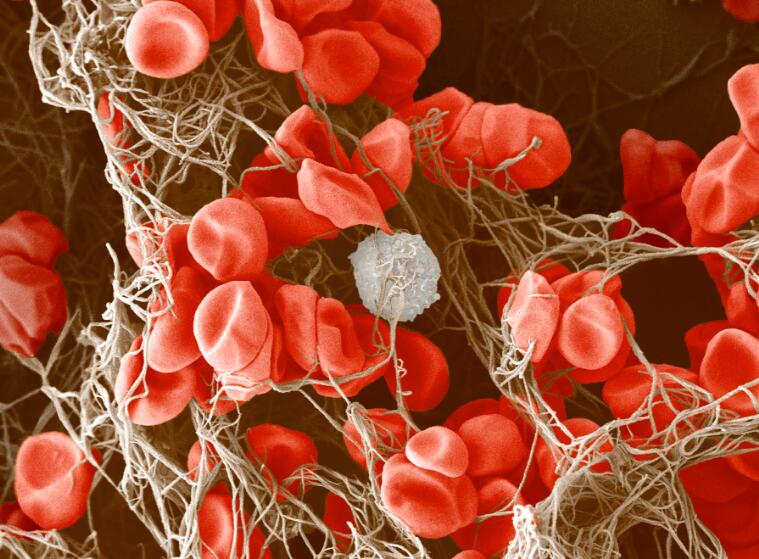 Blood clot in a vessel