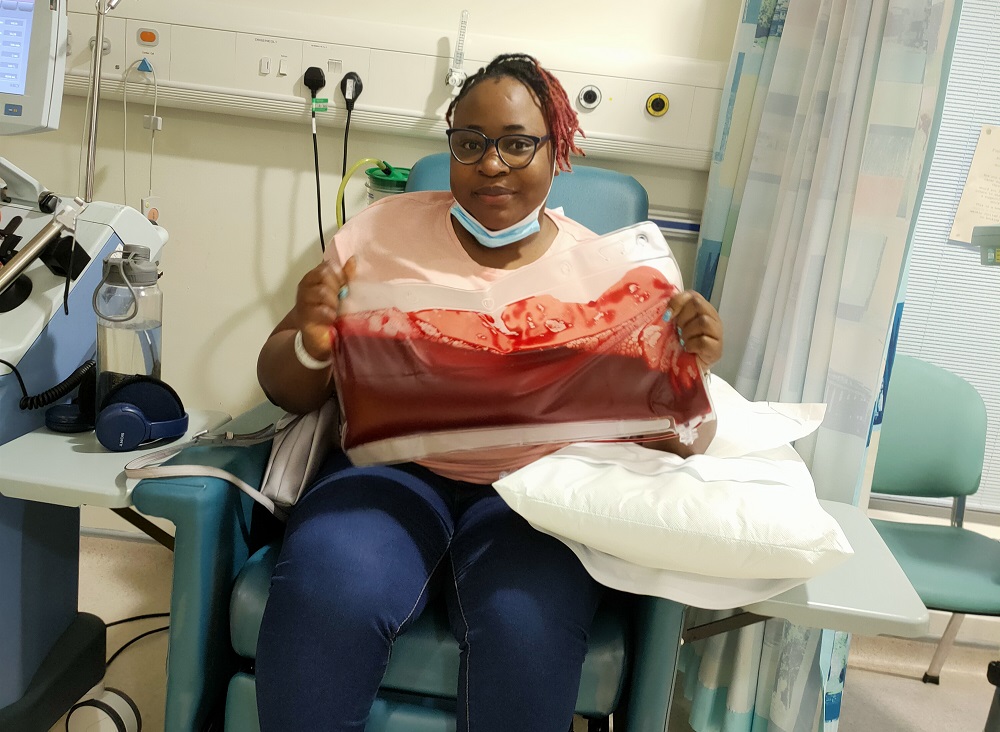 Oyesola with sickled blood cells removed during blood exchange transfusion