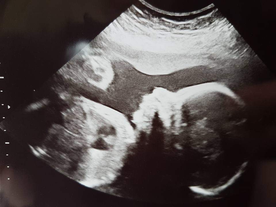 Laura's 20 week pregnancy scan