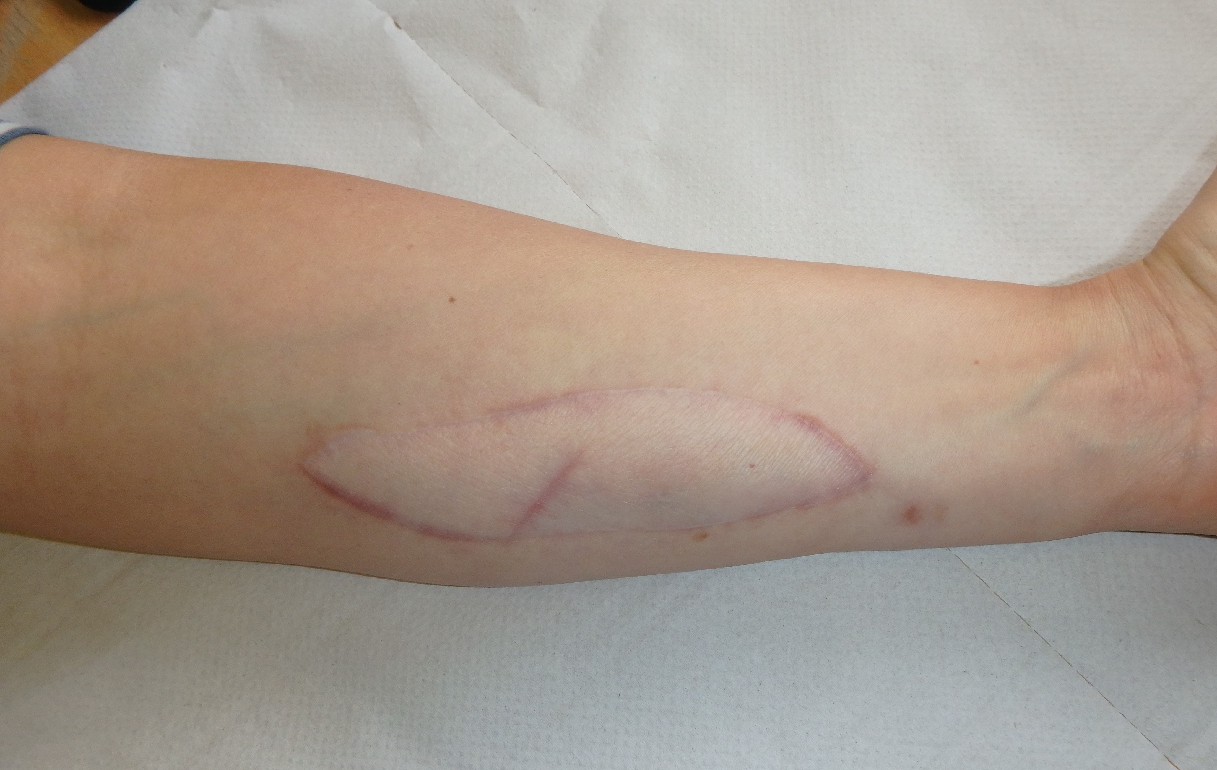 Skin patch from the forearm of the organ donor which is transplanted onto the under-surface of the patient's forearm