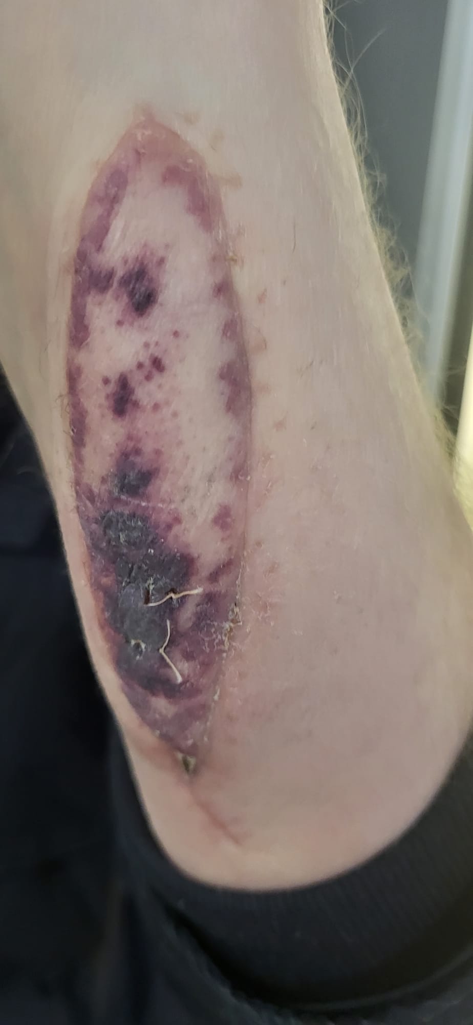 Donor skin patch showing rash on transplant recipient's arm